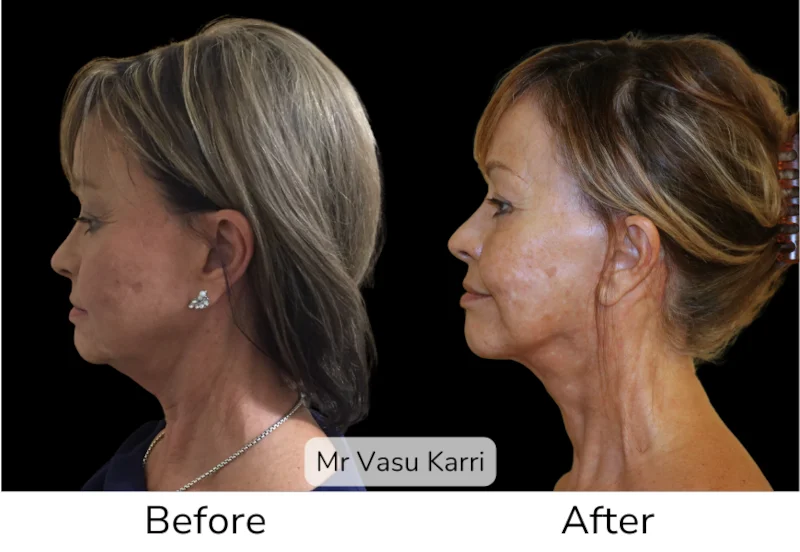 Facelift Patient 7 View 2